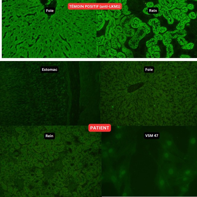 تحليل ASMA / AAML — الأجسام المضادة للعضلات الملساء