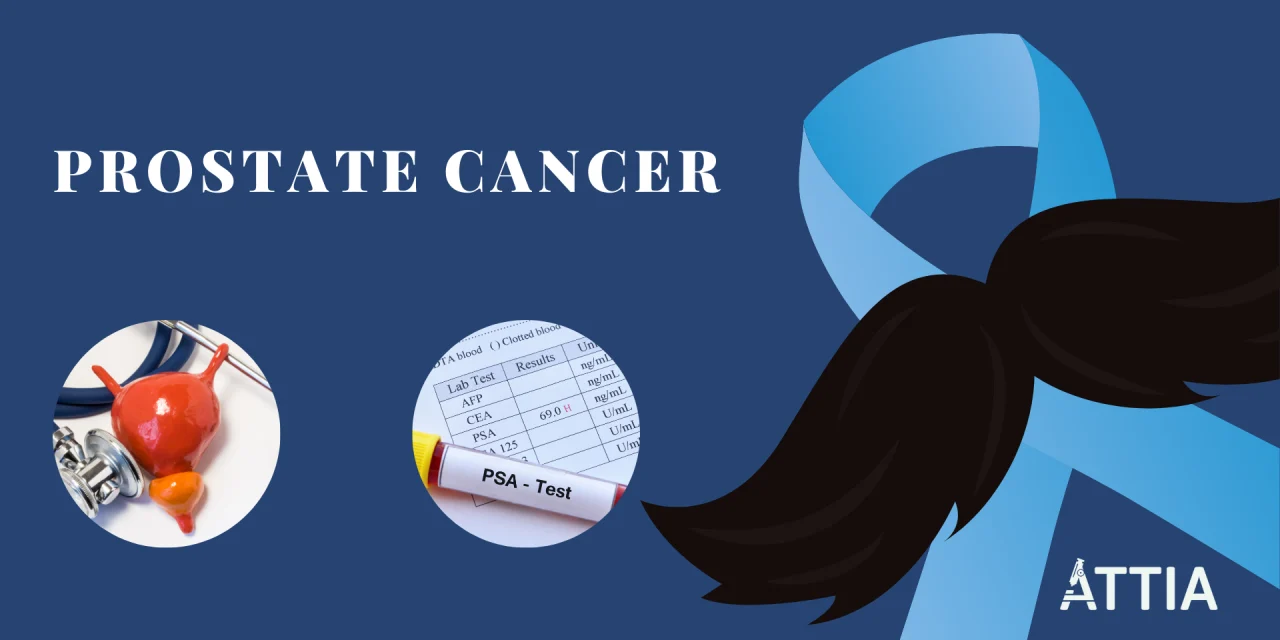 L’importance du PSA dans le dépistage précoce du cancer de la prostate